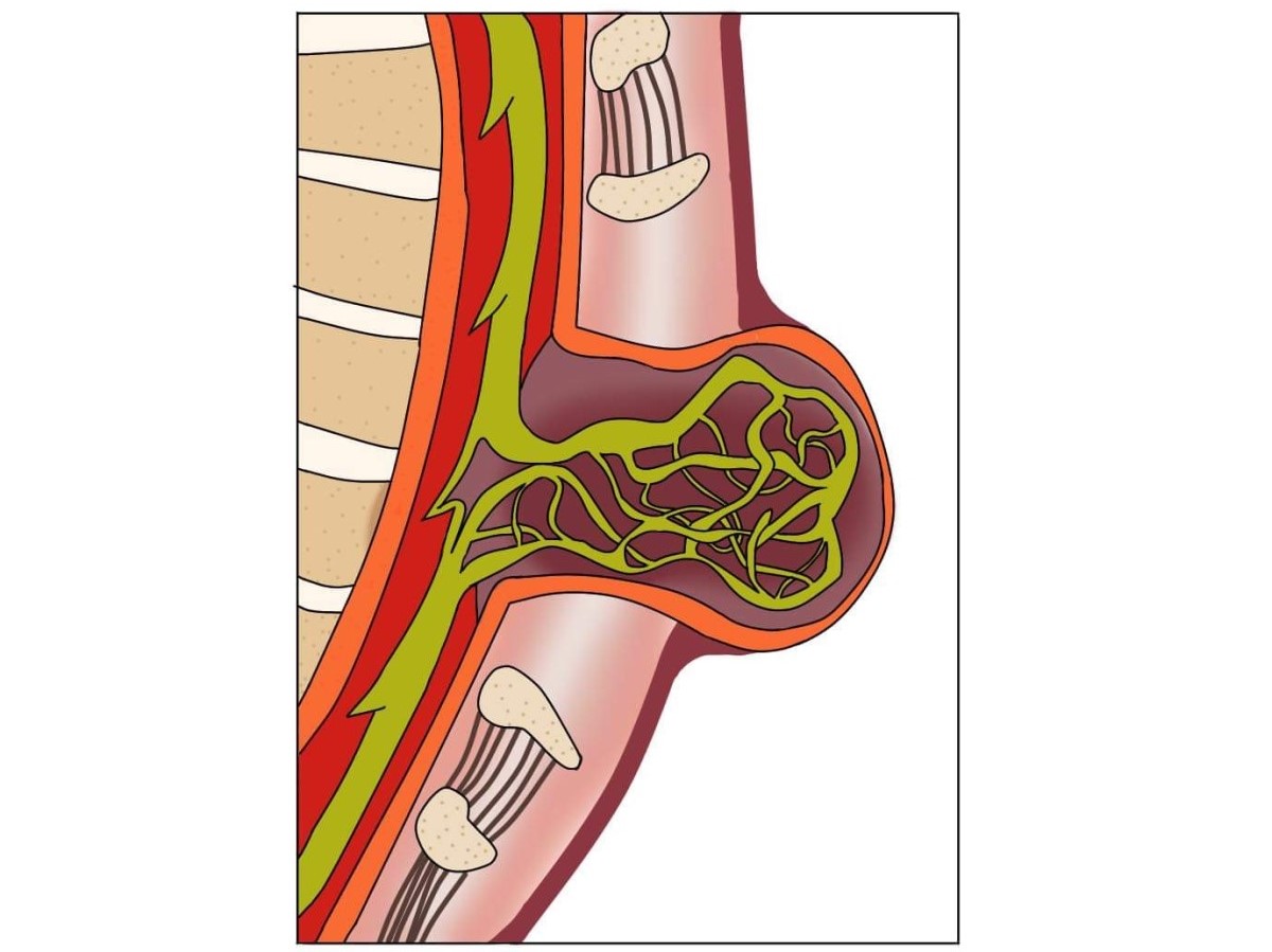Myelomeningokéla, otvorený rázštep chrbtice s vytláčajúcou miechou a miechových nervov